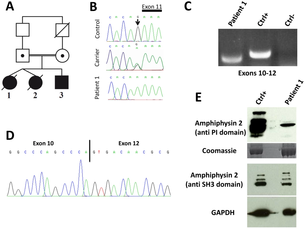 Human <i>BIN1</i> mutation of the exon 11 acceptor splice site and impact on splicing.