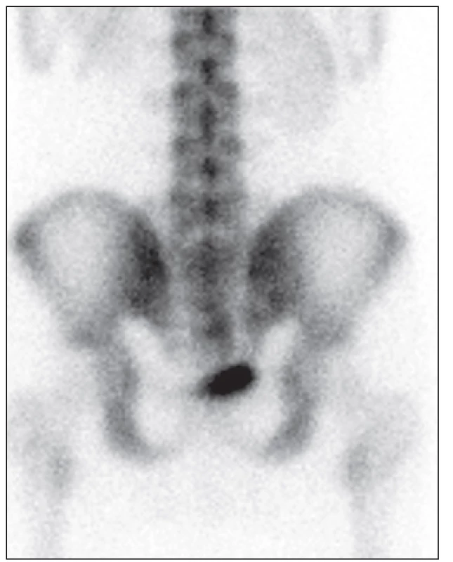 <i>Třífázová scintigrafie skeletu – 3. fáze (zadní pohled): v oblasti os sacrum vpravo nedochází ke zvýšené akumulaci radiofarmaka</i>