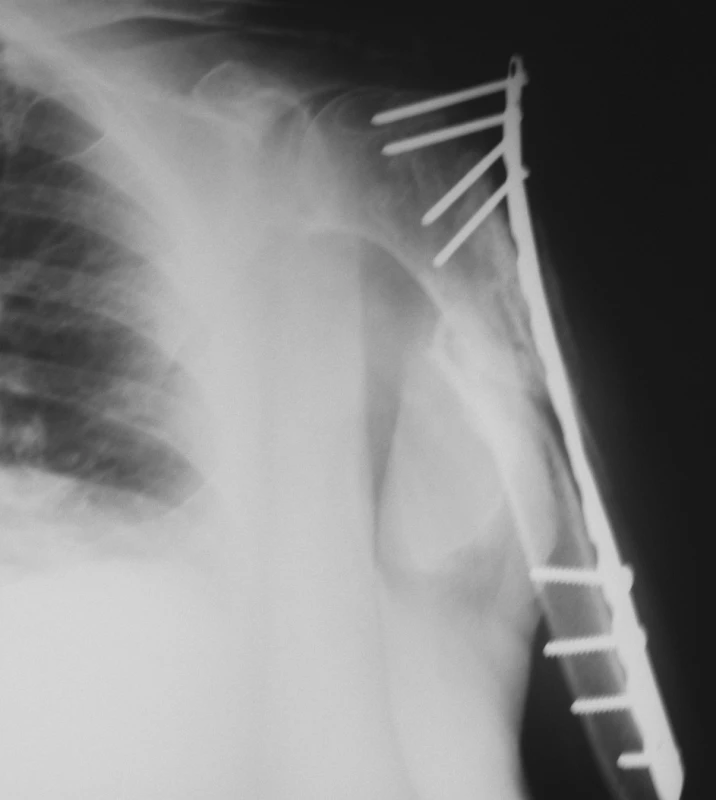 Selhání osteosyntézy
Pic. 5. Osteosynthesis failure
