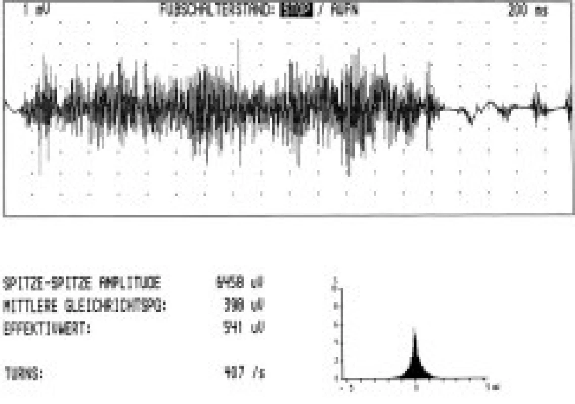 Turns/amplitude analysis u pacienta s tonickou formou dystonické kontrakce (levostranná torticollis). Záznam z m. splenius capitis vlevo, počet turns/sekunda 407.