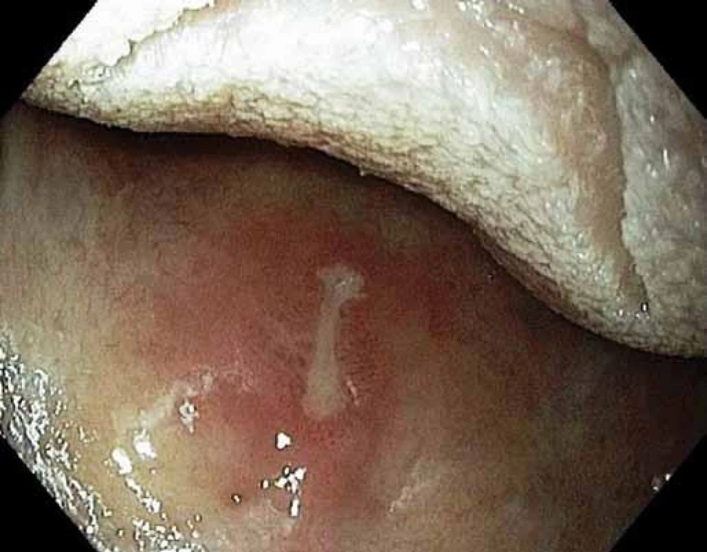 Aftózní vřed orofaryngu.
Fig. 3. Aphtous oropharyngeal ulcer.