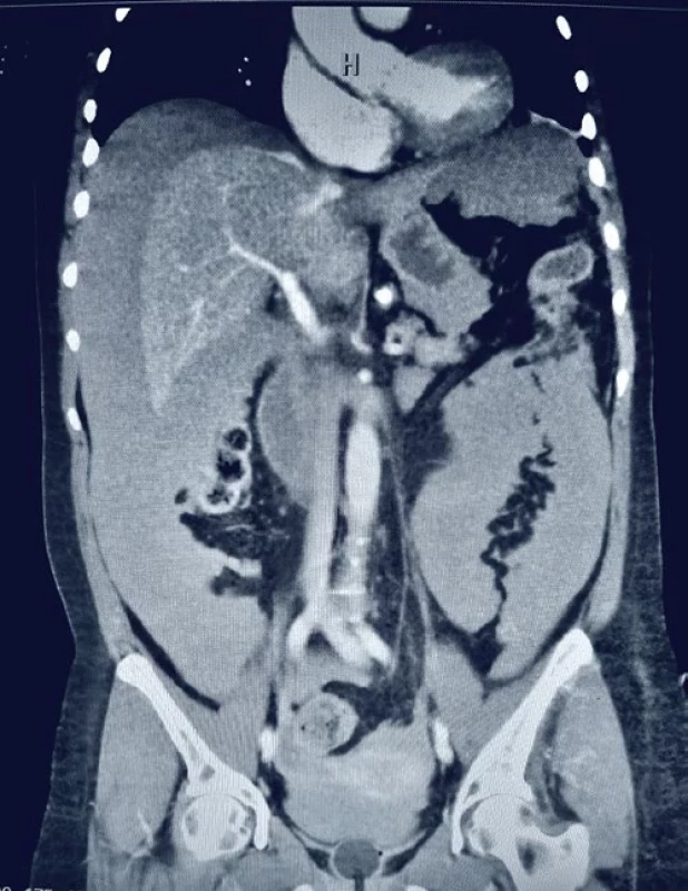 CT kontrastní vyšetření břišní dutiny s průkazem masivního hemoperitonea a krvácení z poraněných jaterních žil.