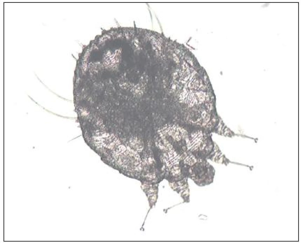 Mikroskopický nález <em>Sarcoptes scabiei</em> (Danilla T.)
