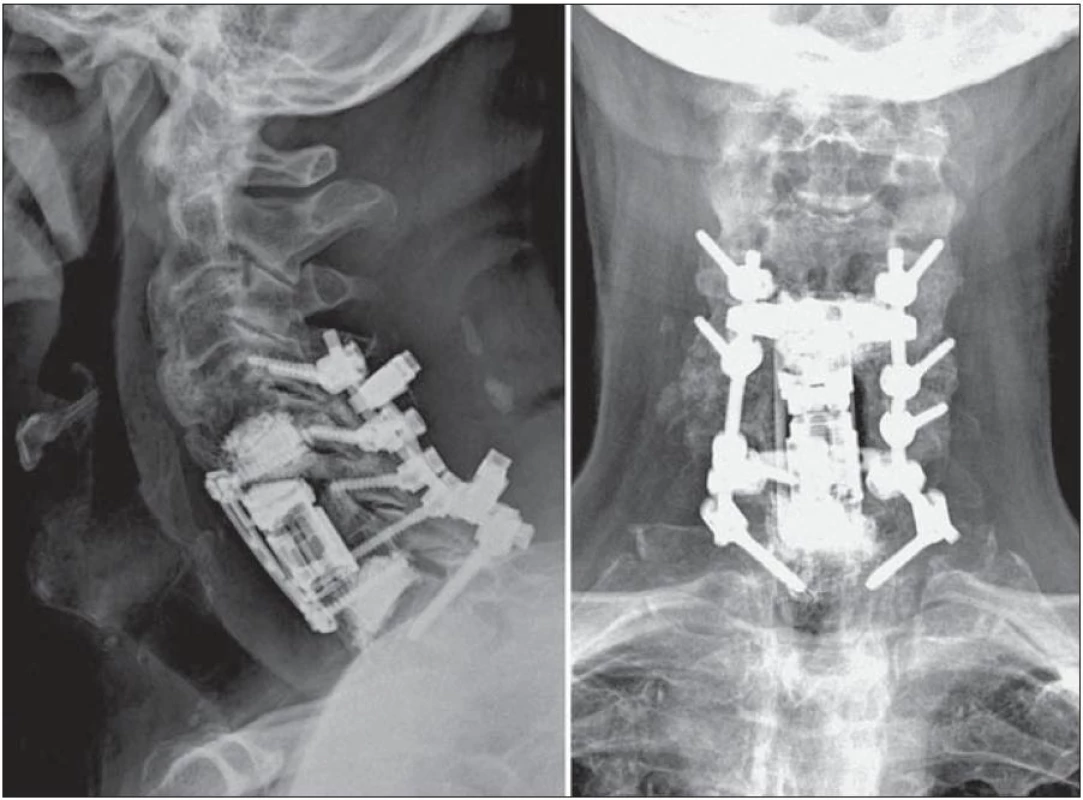 Definitivní morfologický nález po reoperaci: zadní fixatér je kombinací transpedikulární stabilizace a stabilizace šroubů v laterálních masách v rozsahu C4–Th1. Přední instrumentarium se skládá z in situ roztažitelného koše, který vyplňuje kostní defekt. Pozici košíku jistí dlaha s bikortikálně zavedenými šrouby. Obratlová těla C5 a C7, v nichž spočívají šrouby, jsou vyplněna vertebroplastickým cementem.
