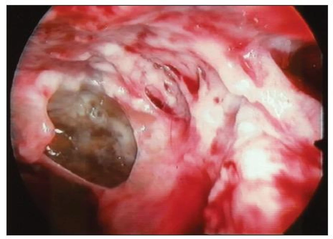 Peroperační snímek chronického pleurálního empyému při VTS
Fig. 3. Intraoperative view of chronic pleural empyema during VTS