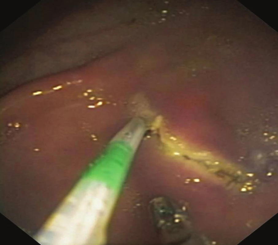 Gastrotomie jehlovým nožem
Fig. 1: Gastrotomy by needle knife