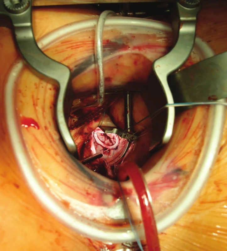 Pravostranná minitorakotomie 
Pohled na plastiku mitrální chlopně (implantovaný prstenec).
Fig. 2: Right minithoracotomy 
Intraoperative view on the mitral valve plasty using prosthetic ring.