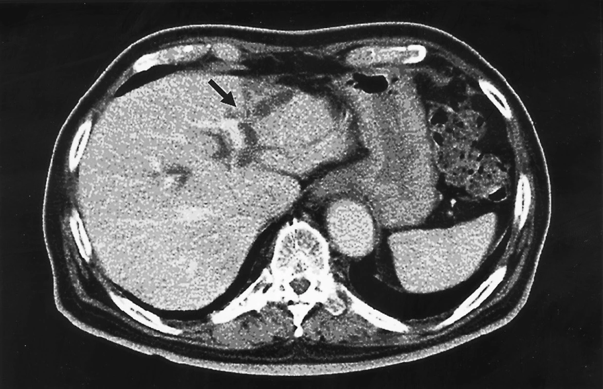 CT kontrastní vyšetření jater ve venózní fázi
Fig. 3. A CT contrast liver examination in the venous phase
Šipkou označené hypodenzní struktury znázorňují dilataci žlučovodů
v SII a SIII segmentu jater An arrow indicates hypodense structures, representing dilation of the bile ducts in the SII and SIII liver segments