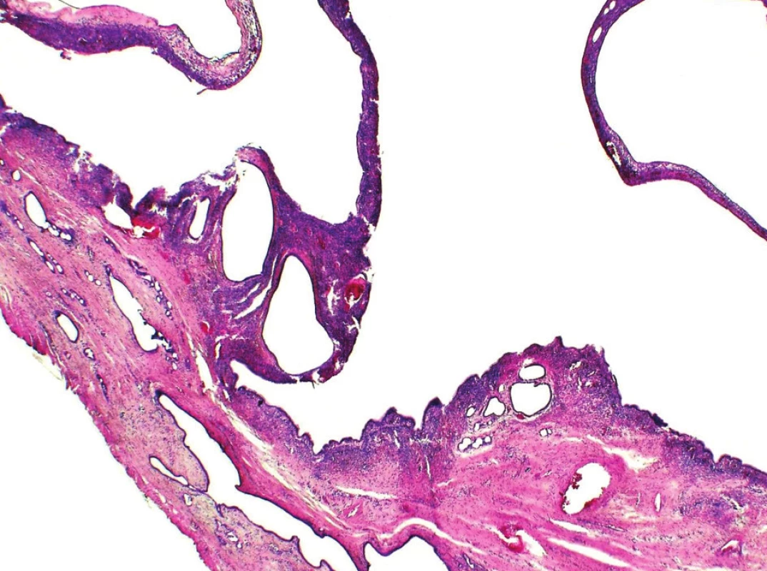 Při malém zvětšení je viditelní multilokulární stavba cystadenomu (HE20x)
Fig. 1. At low magnification a multilocular structura of cystadenoma is distinelly visible