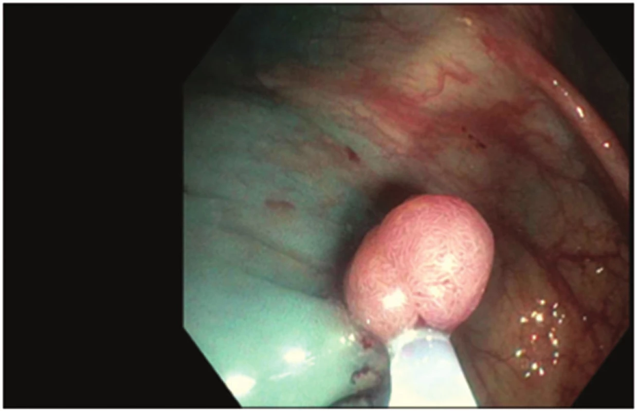 Odstranění polypu metodou endoskopické polypektomie
Fig. 1: Polyp removal by endoscopic polypectomy