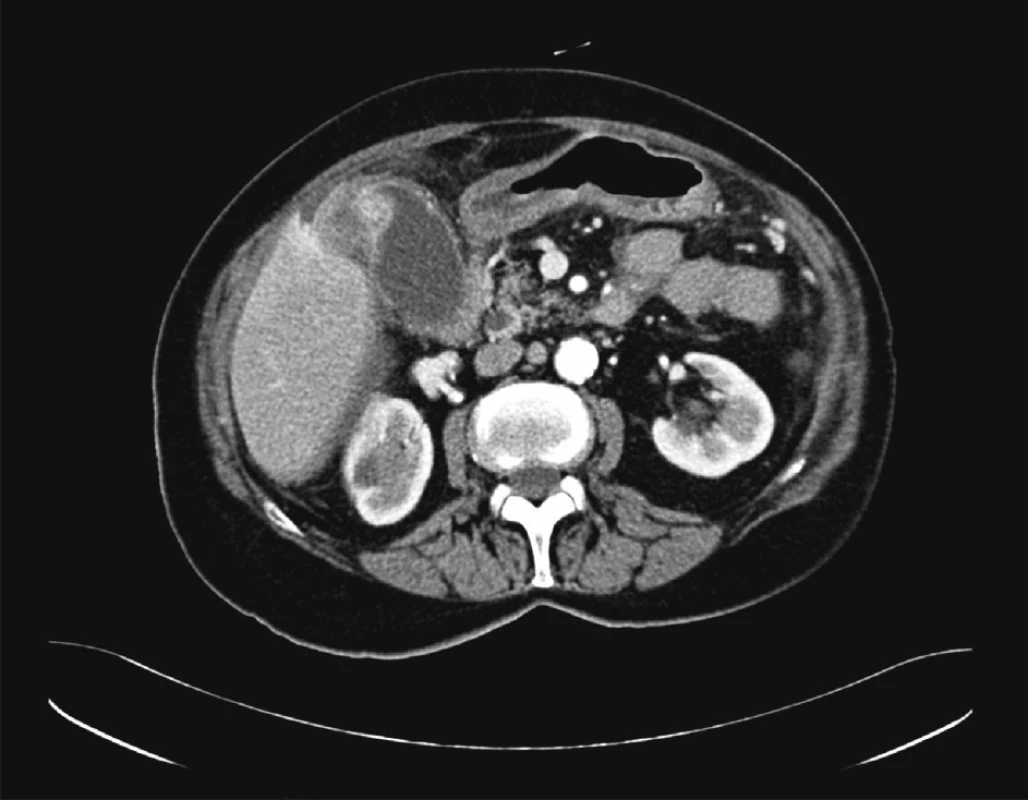 Předoperační CT, transverzální řez
Fig. 2. Preoperative CT, transverse section