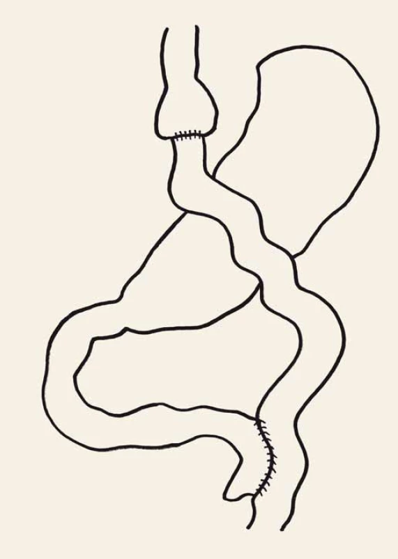 Roux-Y gastrický bypass.
Fig. 3. Roux-en-Y gastric bypass.