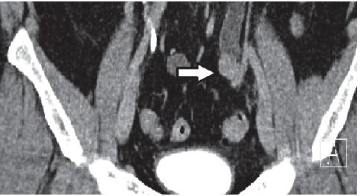 CT po podání intravenózní kontrastní látky – šipka ukazuje na tumor močovodu
Fig. 3. CT after administration of intravenous contrast material – the arrow points to the tumor ureter