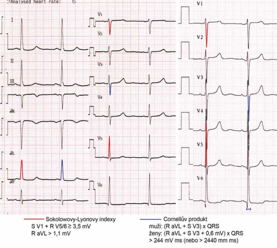 Obraz hypertrofie levé komory na EKG. Pro hypertrofii LK svědčí Sokolowovy-Lyonovy indexy (součet hloubky kmitu S ve svodu V1 a výšky R ve V5 nebo V6 je zde 4,1 mV, velikost kmitu R ve svodu aVL 1,2 mV) i Cornellův produkt ( je 270 mV msec). Lze si povšimnout, že na prvním EKG byla v končetinových svodech přístrojem automaticky zvolena nižší voltáž 5 mm/mV, záznam z hrudních svodů na dalším EKG vpravo je natočen se standardní voltáží 10 mm/mV.