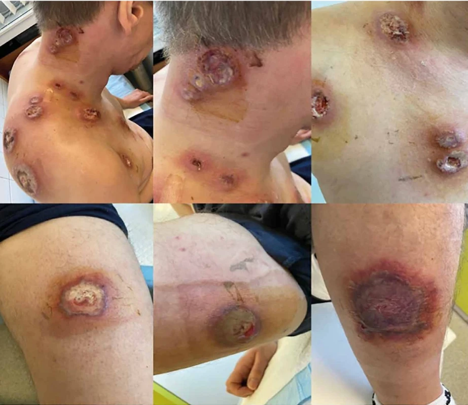 Mnohopočetné ložiská PG s dominujúcou zápalovou zložkou