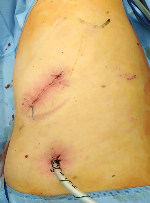 Biportální robotická dolní lobektomie levé plíce, incize    Fig. 1: Biportal robotic left lower lobectomy; incisions