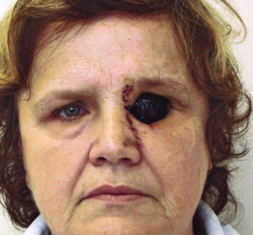 Pacientka po operaci s ponechanou volnou trepanační dutinou, trepanační dutina ponechána ke spontánnímu přegranulování.