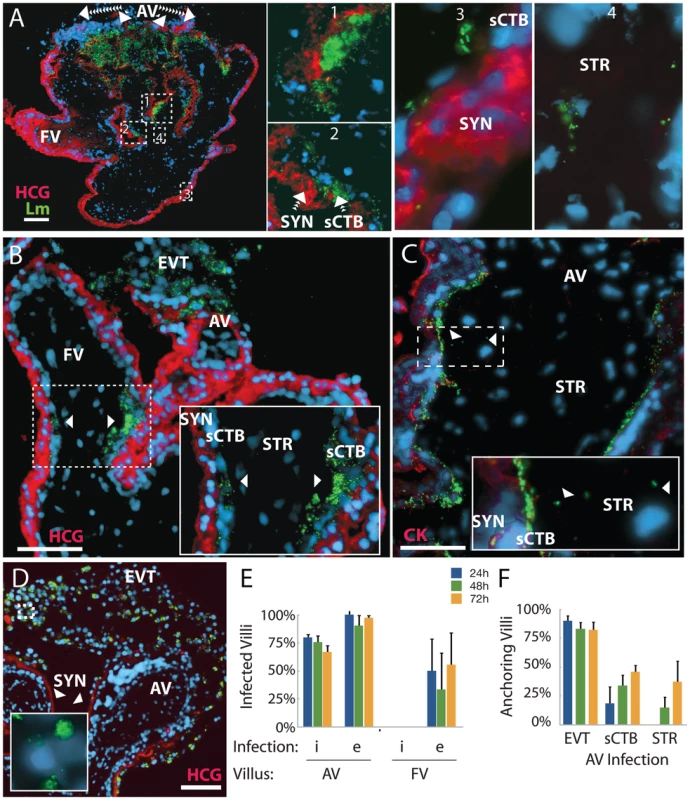 Infection progresses from extravillous cytotrophoblasts to stroma over 72 hours.