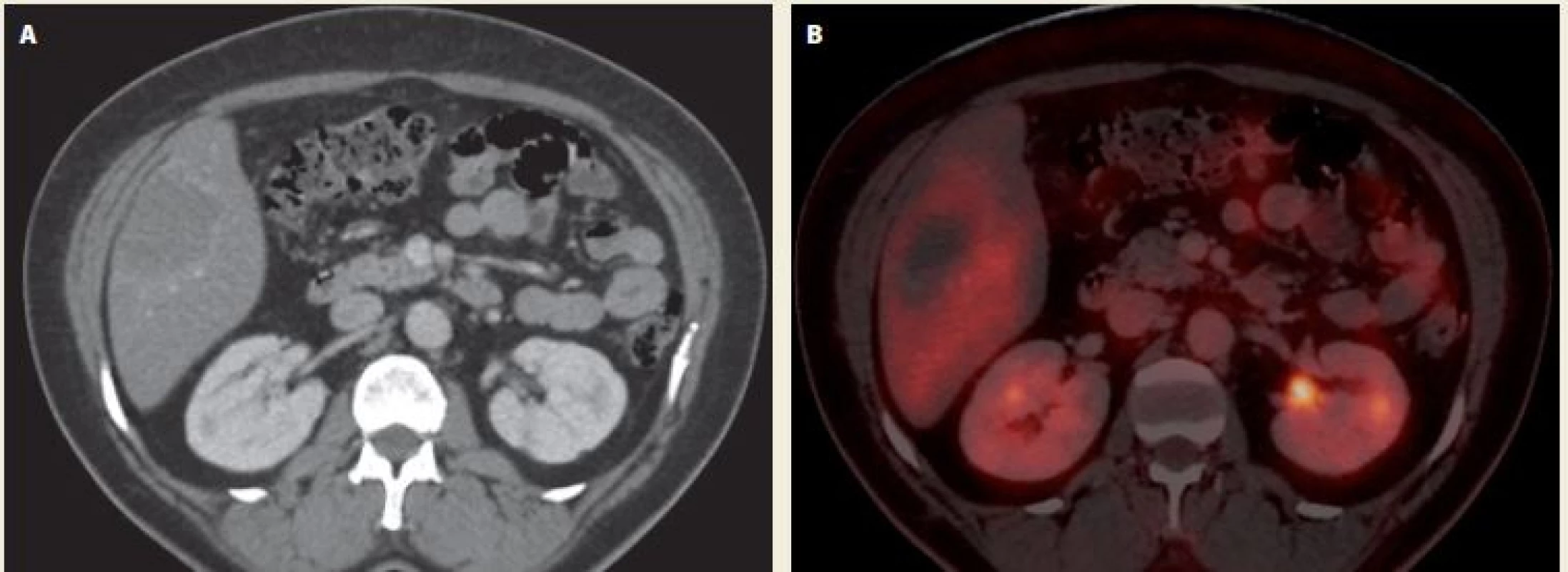Echinococcal liver lesion on PET/CT after 1-year treatment with albendazole – A. contrast enhanced CT – axial
scan; B. fusion – axial scan. After intravenous application of a contrast dye, there is a discrete saturation hem around a hypodense
lesion in the 5th liver segment. In the fusion images of the 5th liver segment, there is a metabolically inactive hypodense
lesion with a discrete post-contrast hem opacity and a complete disappearance of a 5 uorodeoxyglucose (FDG) accumulation
over the surrounding hepatic parenchyma. Source: Department of imaging methods, T. Bata Regional Hospital, Zlín.<br>
Obr. 2. Echinokokové postižení jater na PET/CT po roční terapii albendazolem – A. CT po aplikaci kontrastní látky intravenózně
– axiální řez; B. fúze – axiální řez. Po aplikaci kontrastní látky intravenózně je patrný diskrétní lem sycení kolem hypodenzního
ložiska v 5. segmentu jater. Na fúzních snímcích v 5. segmentu jater je patrno metabolicky neaktivní hypodenzní ložisko s diskrétní
postkontrastní opacifikací lemu a úplným vymizením akumulace 5 uorodeoxyglukózy (FDG) oproti okolnímu jaternímu
parenchymu. Zdroj: Oddělení zobrazovacích metod, Krajská nemocnice T. Bati, Zlín.