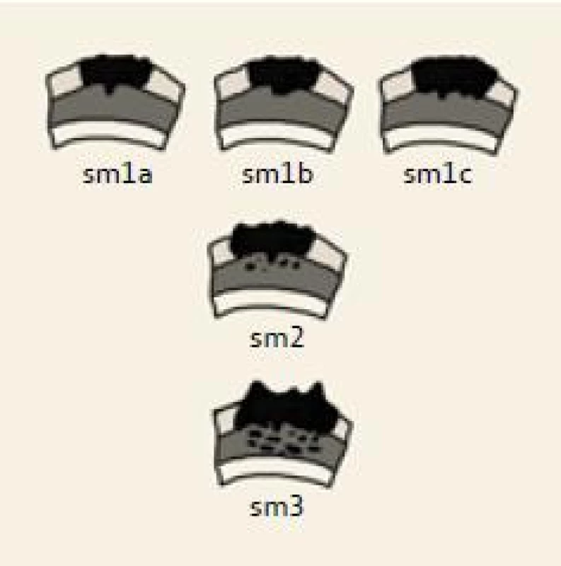 Schematické znázornění invaze do submukózy, klasifikace dle Kikuchi et al, 1995 [8].
Fig. 1. Scheme of submucosal invasion, classification according to Kikuchi et al, 1995 [8].