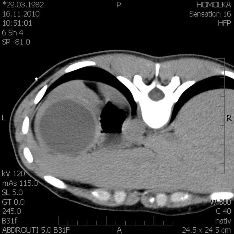 CT nález před drenáží (kazuistika 1)
Fig. 2: CT view, prior to drainage (case 1)
