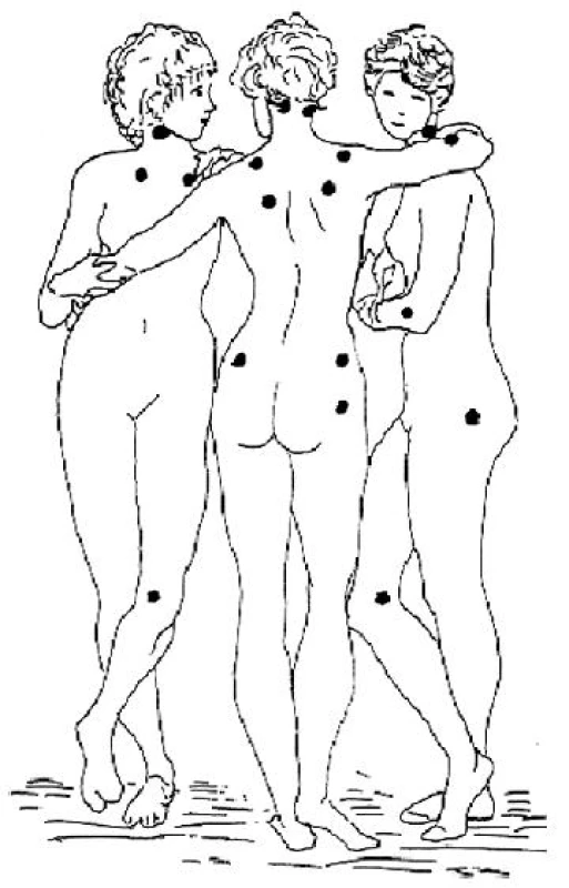 Lokalizace 18 definovaných bolestivých bodů u fibromyalgie podle klasifikačních kritérií American College of Rheumatology (Wolfe et al., 1990; podle Pavelka K. et al (2003), obrázek použit se svolením hlavního autora)