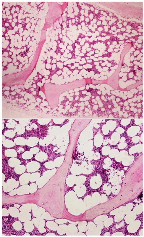 Photomicrographs of a histological section from bone marrow core biopsy showing normocellular marrow without intrasinusoidal infiltration of lymphoma
A) H &amp; E stain, original magnification x 4, B) H &amp; E stain, original magnification x 10