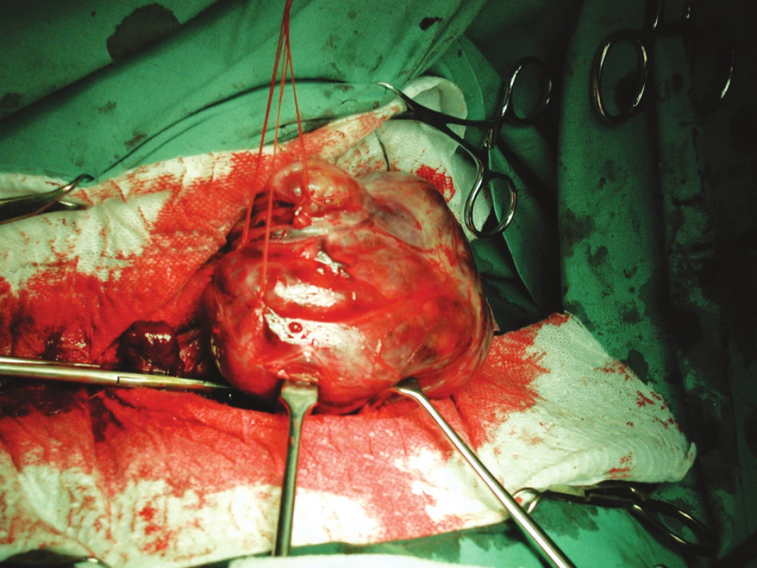 Peroperační foto – odpreparovaný rozsáhlý uzel, který komprimoval tracheu.
Fig. 1. An intraoperative photograph – dissected large thyroid nodule that compressed the trachea