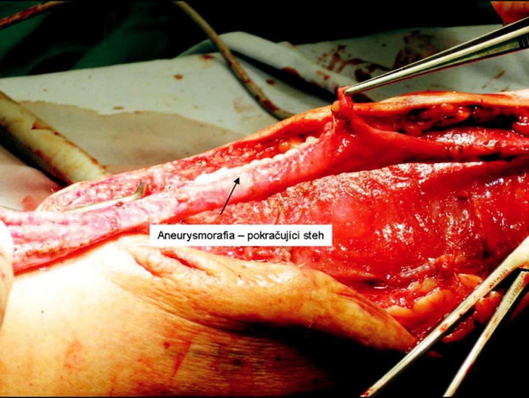 Aneurysmorrhafia
Fig. 7. Aneurysmorrhaphy