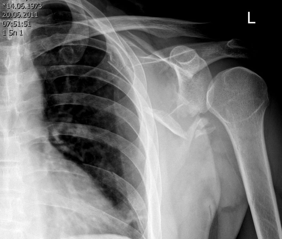 Přehledný snímek levého ramenního kloubu – lze na něm identifikovat zlomeninu laterálního okraje lopatky, nelze však přesně určit její typ
Fig. 1: Radiograph of the left shoulder showing a fracture of the lateral border of the scapula; however, its type cannot be exactly determined