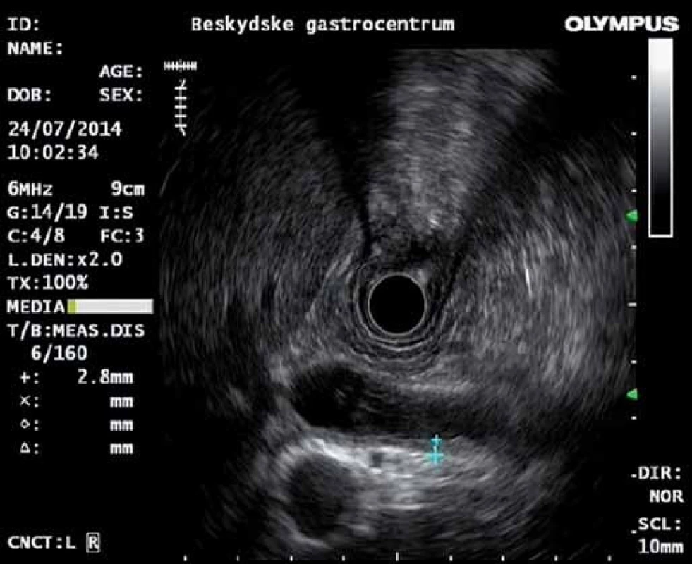 EUS: dilatace d. choledochus, hypoechogenní ztluštění jeho stěny.
Fig. 4. EUS: dilatation of the common bile duct, hypoechogenic thickenning of its wall.