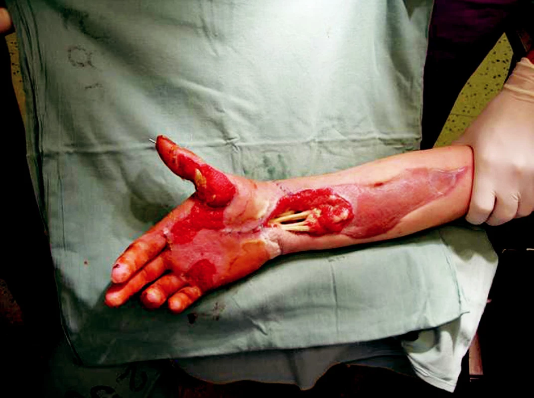 Right upper extremity 30th day after the injury