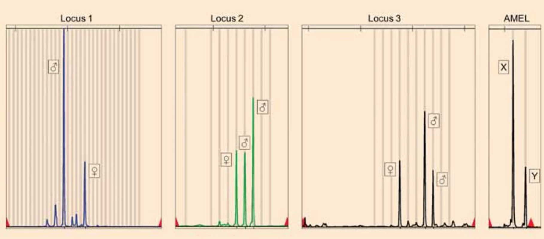 Results of STR genotyping of the partial mole.</br>Loci proving the presence of three paternal (nonmaternal) alleles (♂) and one maternal allele (♀) in the partial hydatidiform mole, which points to a triandric monogynic tetraploid genome composition. The parental origin of the alleles was determined by comparison with STR genotyping results of the blood of the patient. Amelogenin (AMEL) locus proves the presence of three X and one Y chromosomes in the partial mole.