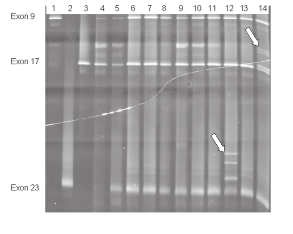 Simultánní vyšetření exonů č. 9, 17 a 23 TSC1 genu metodou DGGE.
Vzorky 1– 3 fyziologické kontroly v jednotlivých exonech, 4– 14 vzorky TSC pacientů; šipky označují záchyt mutace v exonu 23 u pacienta č. 12 a v exonu 17 u pacienta č. 14.