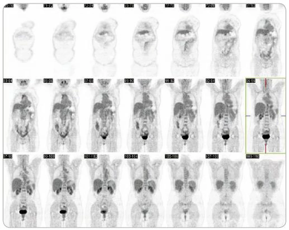 Závěrečné PET/CT vyšetření. Závěrečné celotělové PET/CT vyšetření prokázalo kompletní remisi původního metastatického postižení.