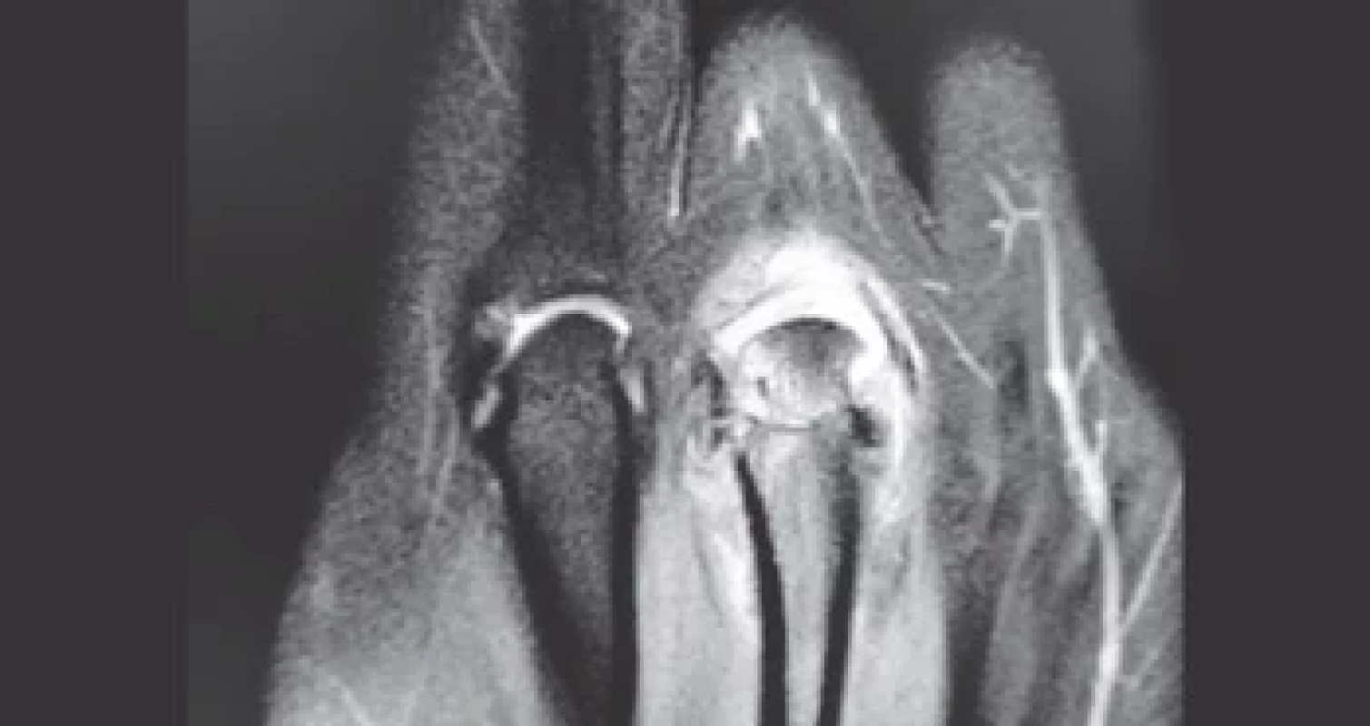 Preoperative MRI: signs of arthritis and cartilage erosion of the joint surfaces.