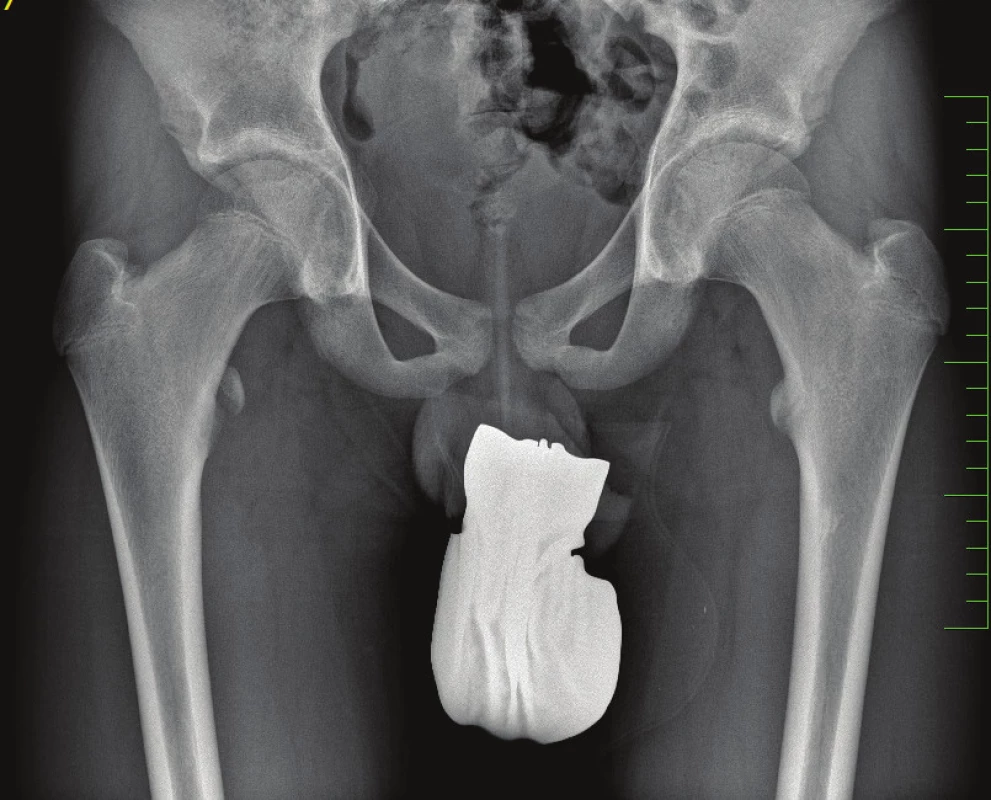 16letý pacient s avulzí malého trochanteru vpravo
Fig. 1: 16-year old patient with avulsion of the right lesser trochanter