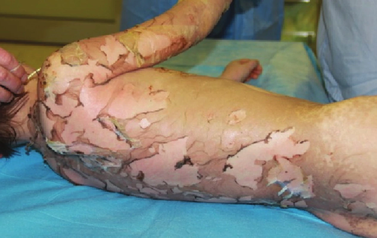 Exfoliované plochy na zádech ve fázi epitelizace
Fig. 3: Exfoliated areas on the back in the epitelization stage