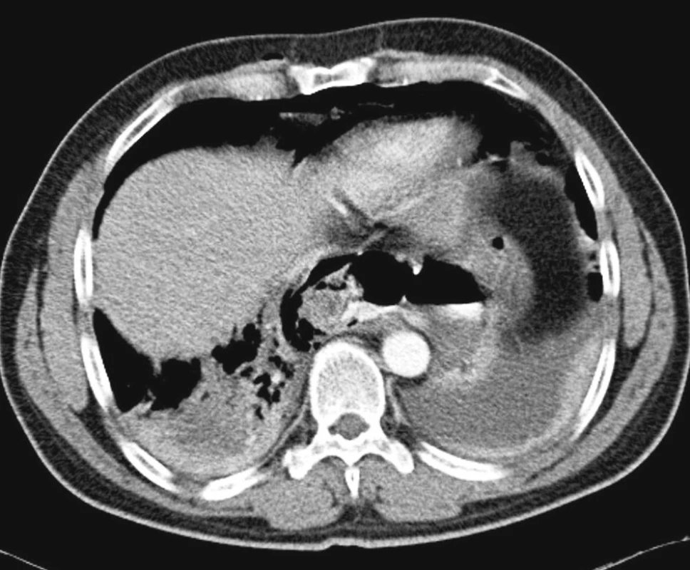 Axiální obraz CT ukazuje vytékání perorálně podané kontrastní jódové látky do mediastina trhlinou v jícnu
Fig. 5. Axial CT view depicting leakage of the orally administered contrast iodine substance into the mediastinum, through the esophageal perforation site