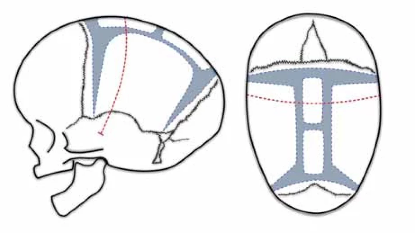 Renier‘s “H” technique
