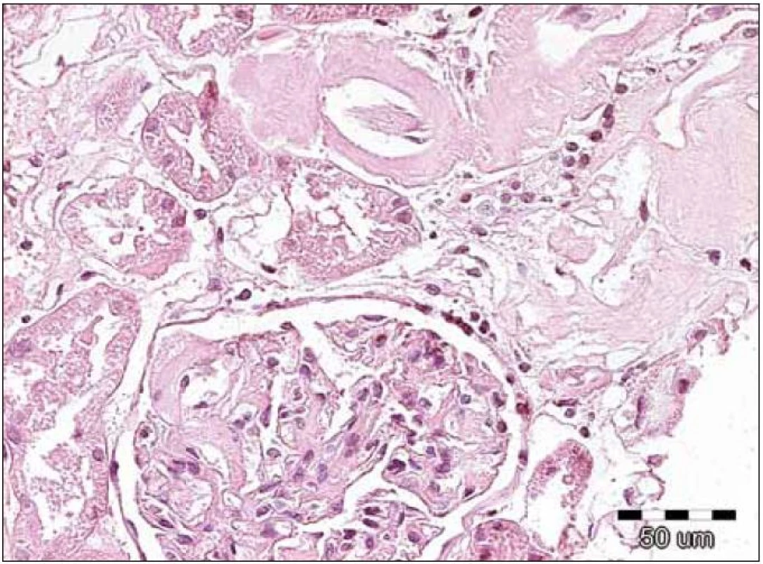 Na obrázku jsou patrná jednak nepříliš nápadná depozita v glomerulu, ale výraznější eozinofilní homogenizace stěn arteriol se zúženými luminy. Přítomnost těchto depozit nutně vede k indikaci dalších speciálních vyšetření, které potvrzují či vylučují přítomnost amyloidových hmot. Barvení hematoxylin‑eozinem, původní zvětšení 200krát.