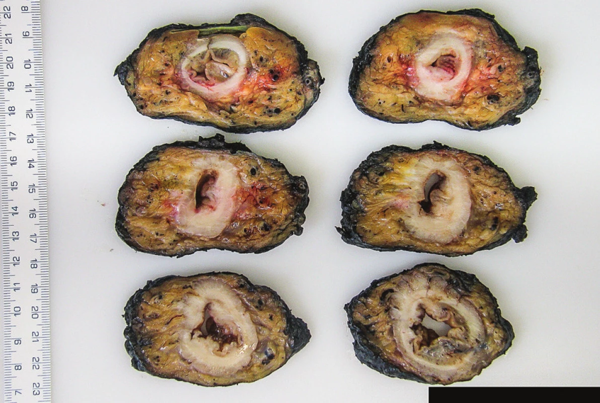 Makrofotodokumentace resekátu a) ventrální strana, b) dorzální strana, c) natušovaný mezorektální tuk, d) sada příčných lamel z místa nádoru.
Fig. 1: Macrophotographs of resection specimen a) ventral aspect, b) dorsal aspect, c) inked mesorectal surface, d) transverse sections of the resection specimen with tumour.