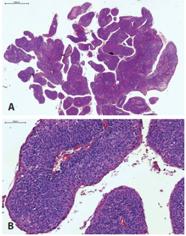 Papilárny SCC s exofytickým papilárnym spôsobom rastu (A), typicky tvorený nekeratinizujúcimi bunkami (B).