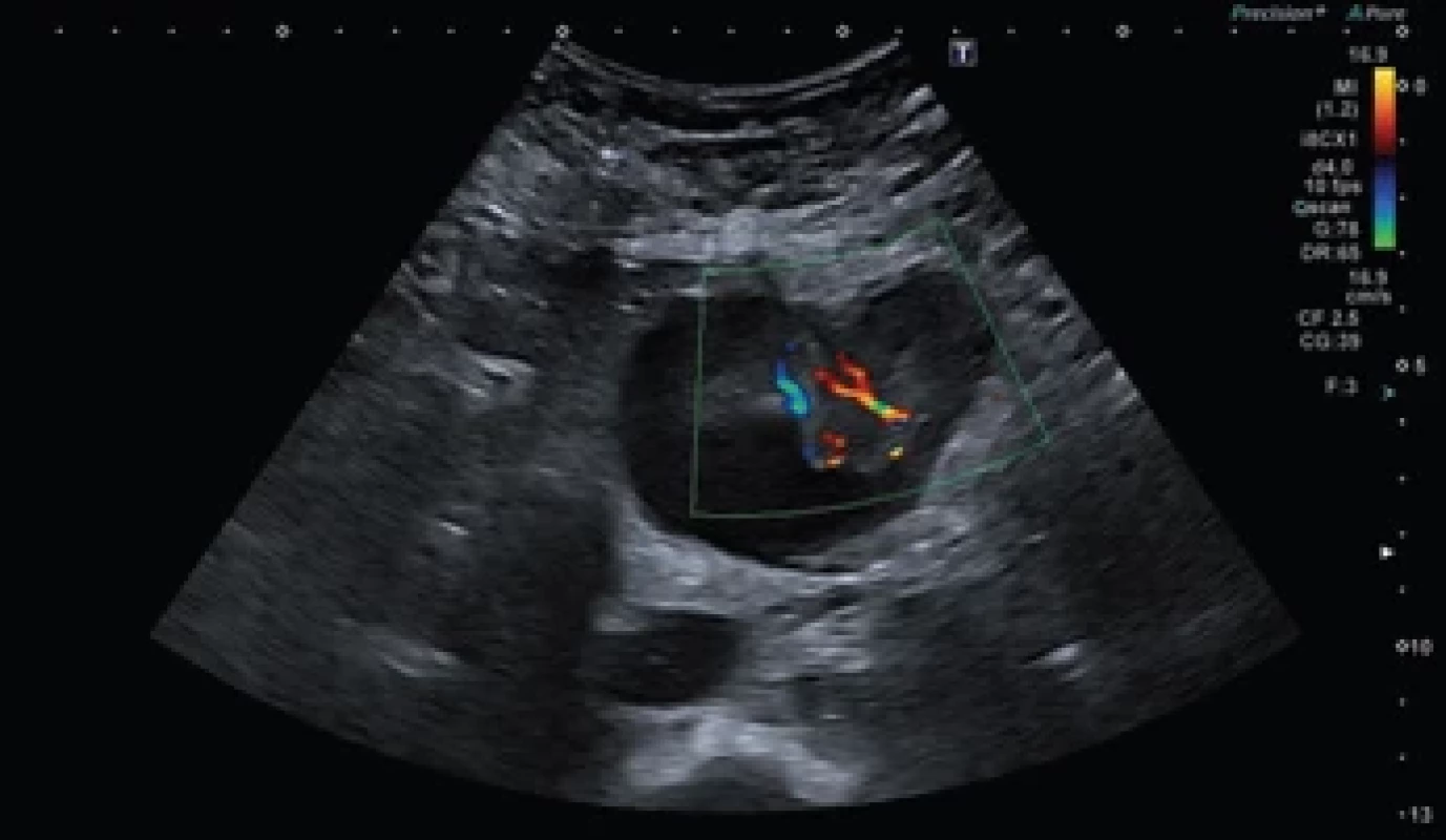 Ultrazvukový snímek tumoru s dopplerem. Fig. 2. Ultrasound scan of the tumour with Doppler.