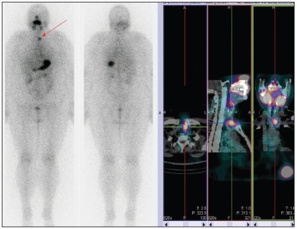 Stejný pacient jako na obr. č. 9, příklad neúspěšné TERJ. 
Vysvětlivky - postterapeutická celotělová scintigrafie a SPECT/CT krku - reziduum štítné žlázy vlevo, pokles Tg na 0,1 μg/l, zvýšená hladina protilátek anti-Tg, v plánu další terapie RJ.