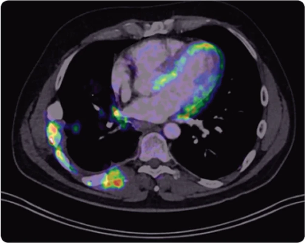 PET CT – nález rozsáhlé infi ltrace hrudní stěny vpravo. 