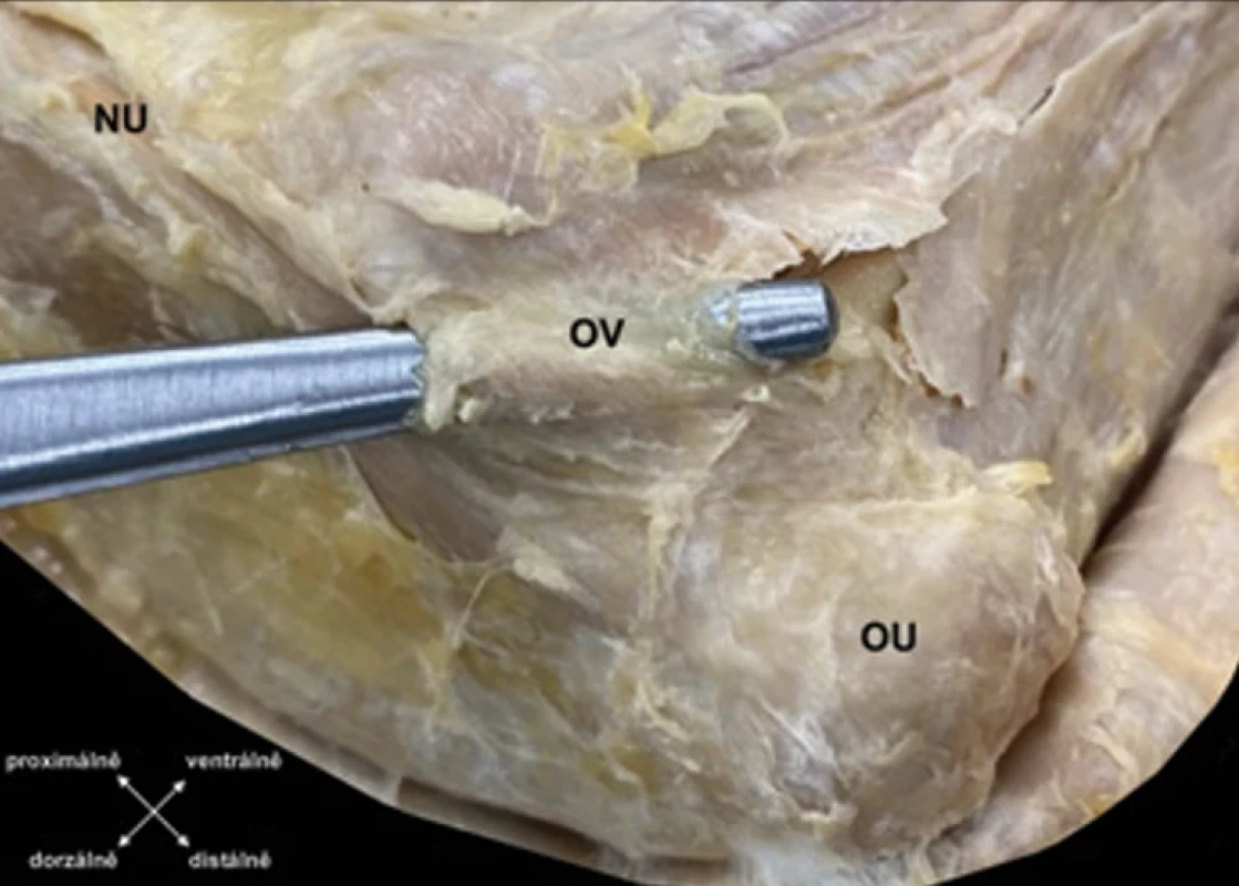 Sonda v proximální části canalis cubitalis krytá Osbornovým vazem.  Fig. 4. Probe in the proximal part of the cubital tunnel covered by Osborne‘s ligament.