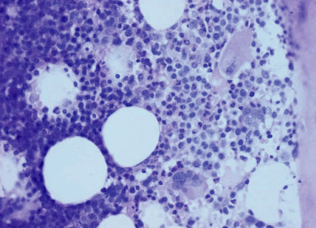 Trepanobiopsie kostní dřeně, HE 400x
– nerovnoměrně buněčná, většinou hypercelulární kostní dřeň s redukovanou granulopoezou s intratrabekulární prekurzorovou složkou (ALIP), dysplastickou erytropoezou s prstenčitými formami, nález odpovídá MDS typu RARS