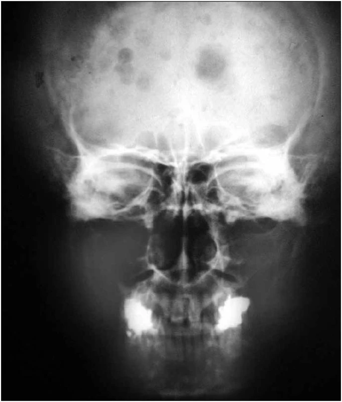 Předozadní RTG snímek s typickými osteolytickými ložisky pro mnohočetný myelom.