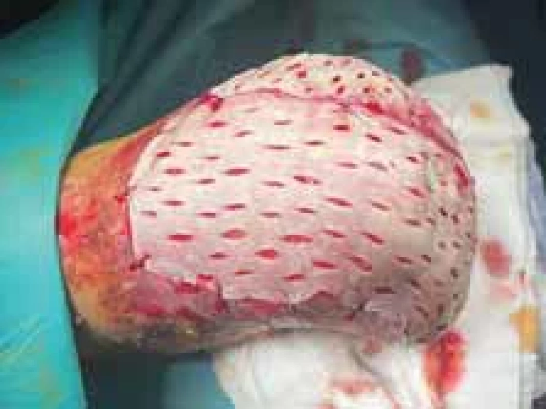 The appearance of the lower limb during operation. Full-thickness skin grafts are visible.